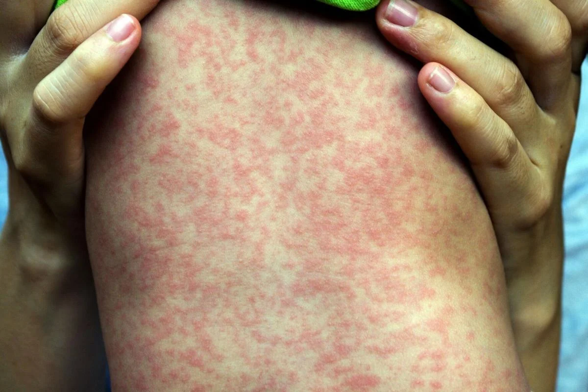 Two dead, nearly 230 sickened in US measles outbreak