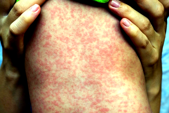 Two dead, nearly 230 sickened in US measles outbreak