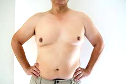 Men with large breasts at higher risk of breast cancer – Expert