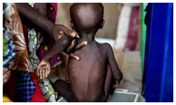 2.9m Nigerian children suffer from malnutrition – UNICEF