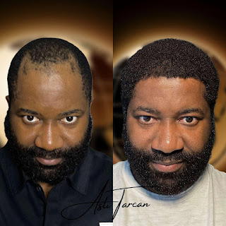 Top 5 Best Afro Hair Transplant Turkey Clinics to Try Out