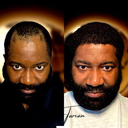Top 5 Best Afro Hair Transplant Turkey Clinics to Try Out