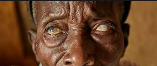 River blindness: Over 43m at risk as Nigeria advances toward elimination target