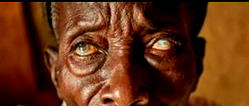 Over 43m risk river blindness as Nigeria moves toward elimination target