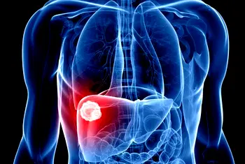 Liver cancer to double worldwide, most of it preventable – Study