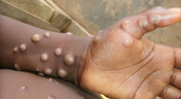 Kaduna to begin monkeypox vaccination in affected LGAs