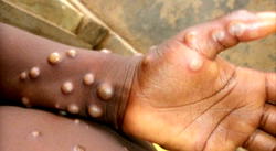 Kaduna to begin monkeypox vaccination in affected LGAs
