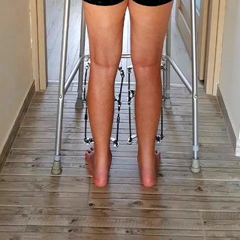 ‘Women now undergo extreme surgery in Turkey to reduce their height’