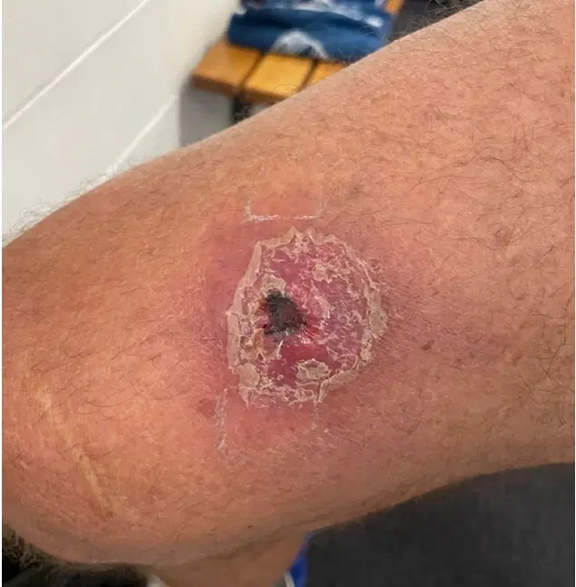 Adamawa confirms eight deaths from suspected Buruli ulcer outbreak