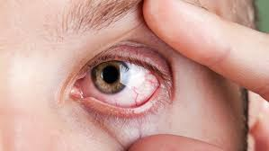 24m Nigerians suffer sight loss, says Prof Uneke