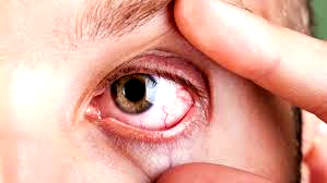 24m Nigerians suffer sight loss, says Prof Uneke