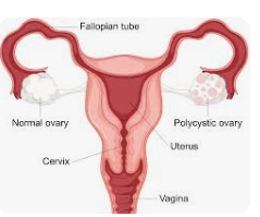 Group tackles burden of misinformation, shame around PCOS