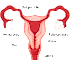 Group tackles burden of misinformation, shame around PCOS