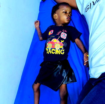 Family seeks N20m for 2-year-old’s heart surgery