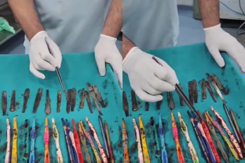 Doctors remove 29 spoons, 19 toothbrushes from patient’s stomach