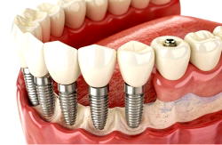 Why Turkey is becoming the global hub for affordable, high-quality dental implants