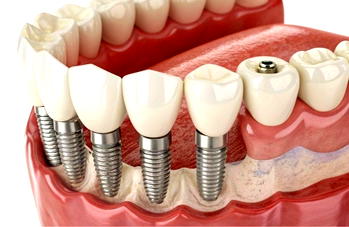 Why Turkey is becoming the global hub for affordable, high-quality dental implants