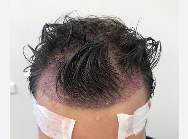 Top-5-Hair-Transplant-Clinics-in-Turkey-1.png