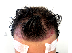 Top 5 Hair Transplant Clinics in Turkey: Cost Breakdown, All-Inclusive Packages, and Quality Standards Analyzed