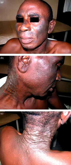 What Nigerians need to know about skin bleaching