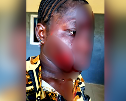 Taraba woman disfigures teenage girl’s face because husband likes her over