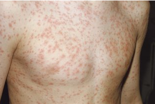 Abia confirms 152 cases of Rubella, sets February vaccination campaign