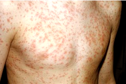 Abia confirms 152 cases of Rubella, sets February vaccination campaign