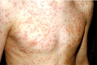 Abia confirms 152 cases of Rubella, sets February vaccination campaign