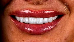 Technique​‍​‌‍​‍‌​‍​‌‍​‍‌ Hollywood Smile 3D: How is Hollywood Smile Done?