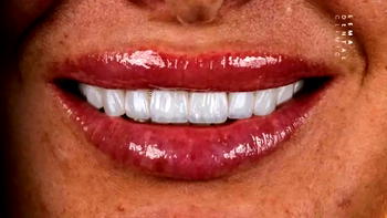 Technique​‍​‌‍​‍‌​‍​‌‍​‍‌ Hollywood Smile 3D: How is Hollywood Smile Done?