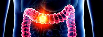 Why are more under-50s getting colorectal cancer? – Report