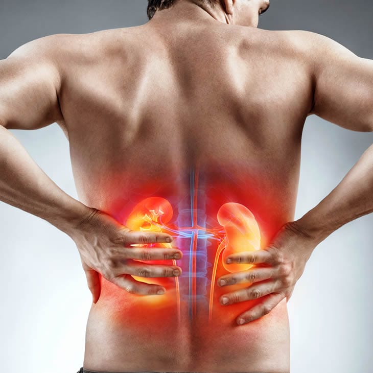 Why 1 in 3 early-stage kidney cancer patients show no symptoms