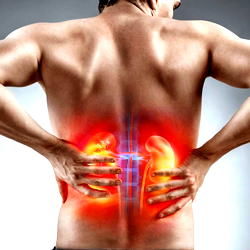 Why 1 in 3 early-stage kidney cancer patients show no symptoms
