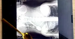 Woman rushed to hospital after swallowing spoon, feels object inside chest