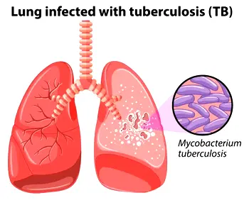 FCT records 16,000 TB cases as treatment success hits 94%