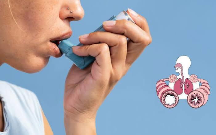 Asthma: Avoid triggers; take medications correctly, keep air clean