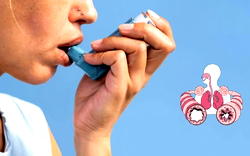 Asthma: Avoid triggers; take medications correctly, keep air clean
