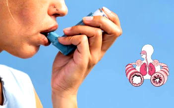 Asthma: Avoid triggers; take medications correctly, keep air clean