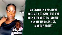 My Swollen Eyes Have Become A Stigma; But I’ve Been Referred To Indian – Susan, Makeup Artist