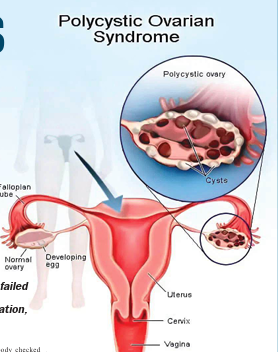 Ovary Syndrom: No one wants to marry a ‘diseased’ woman!