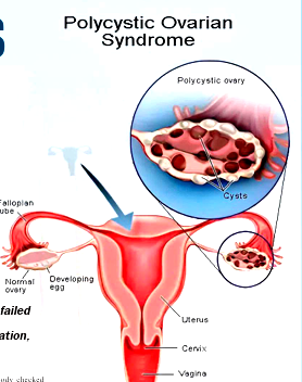 Ovary Syndrom: No one wants to marry a ‘diseased’ woman!