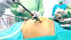 Beyond Surgery: Can nutrition and lifestyle help prevent uterine fibroids?